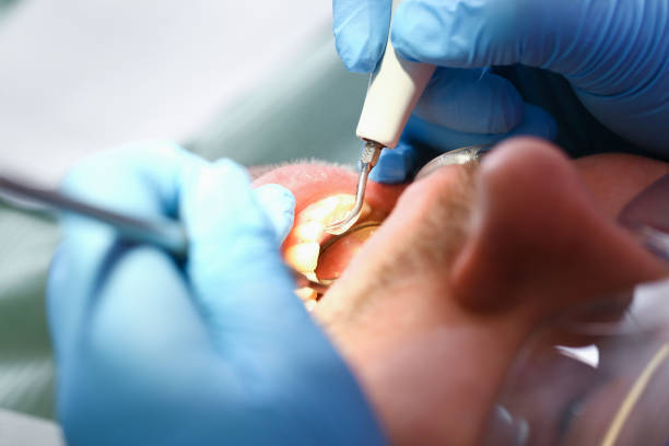 Best Chipped Tooth Repair Near Me  in Dublin, PA